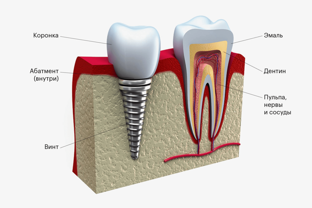 Методы имплантации зубов на Римской