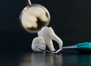 Виды удаления зубов на Римской