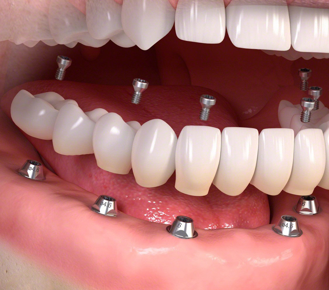 виды несъемного протезирования на своих зубах и имплантатах
