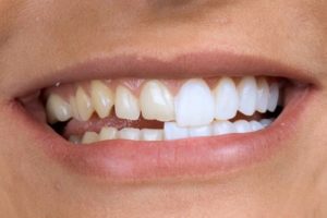 реставрация зубов в москве м римская при любой степени деформации