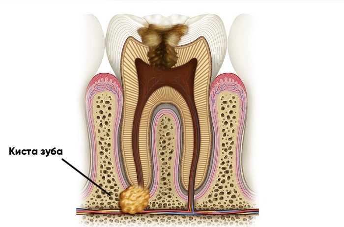 Лечение киста зуба