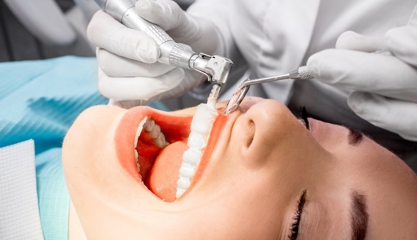 Методы снятия зубных отложений