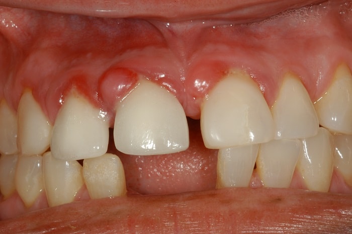 Гранулема зуба лечение