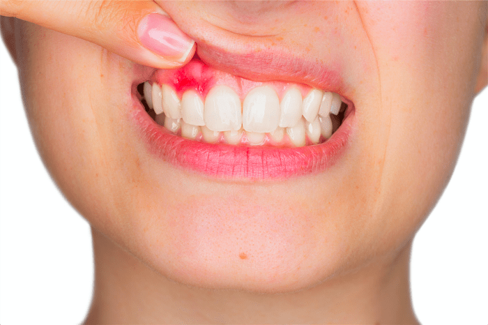 Воспаление десны около зуба лечение